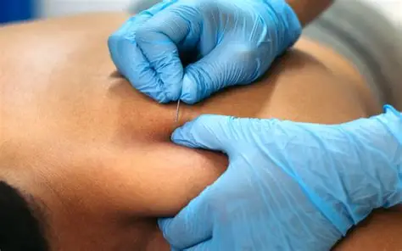 Dry needling